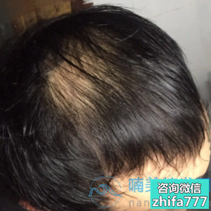 北京新生稀少加密种植，头发非常稳固