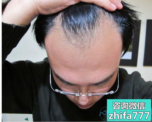 武汉大麦发际线种植，终于可以随意变换发型了