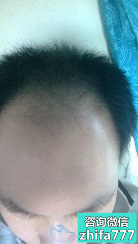 南京新生秃顶植发，让我找回自信了