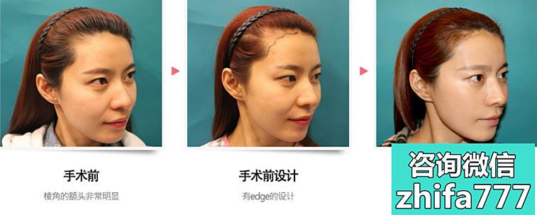 韩国毛杰琳女性迷你发际线矫正手术效果图