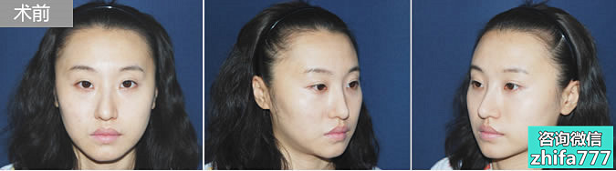 韩国多娜医院帮助女性患者侧面发际线调整案例