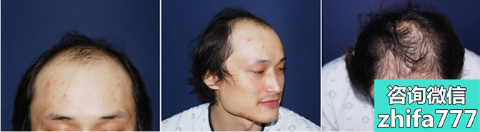 韩国多娜为大面积脱发患者实施植发手术