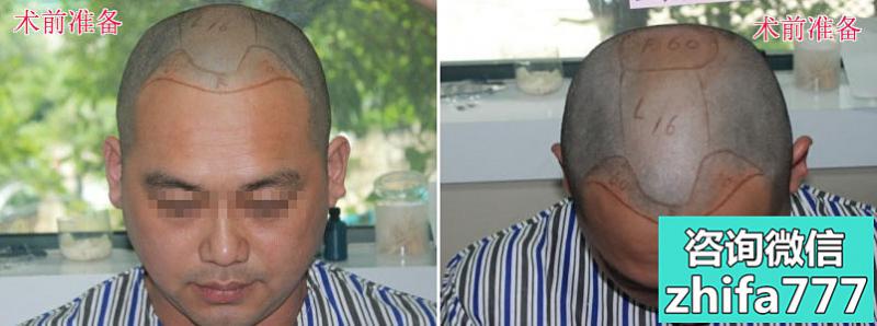 武汉华美植发为患者种植3400毛囊8个月效果