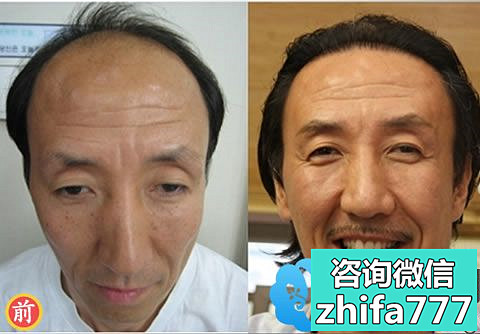 韩国黄盛柱植发案例 男性教练植发治疗秃顶经历
