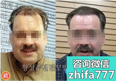 韩国黄盛柱植发案例 植发治疗50岁男性的M型脱发
