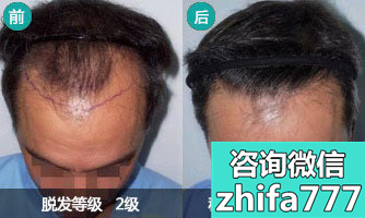 重庆迪邦男性植发真实案例 成功摆脱M字型发际线