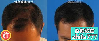北京第三医院谢祥植发真实案例 男性四级脱发植发效果
