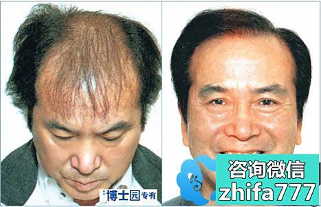 石家庄博士园植发案例 植发治疗男性秃顶手术