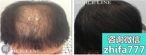 韩国Noble Line植发治疗头项严重脱发案例