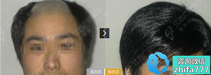 江西广济医院毛发移植案例 重塑线际线 头发加密
