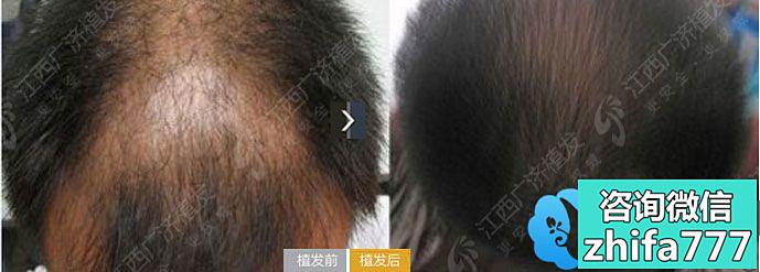 江西广济医院毛发移植案例 卷发移植 头发加密手术