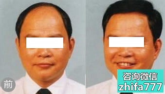 上海新极点植发中心 自体毛囊移植案例