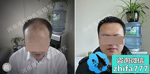 郑州现代中医院植发案例 男性治疗秃顶效果
