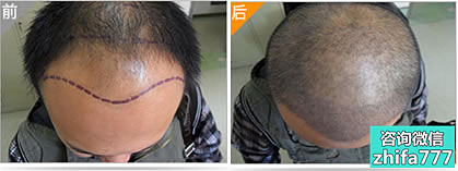 南京韩辰发线际种植真实案例 男性M型发际线矫正效果