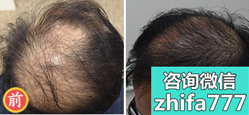 中国台湾瑞丝得植发案例 男性头顶稀疏加密手术