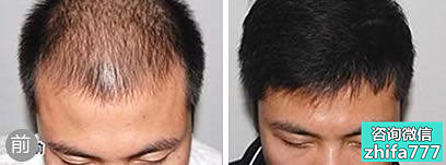 呼和浩特伊思植发案例 严重脱发患者进行植发手术
