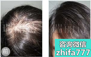 西安植发案例 PHT植发治疗女性产后脱发