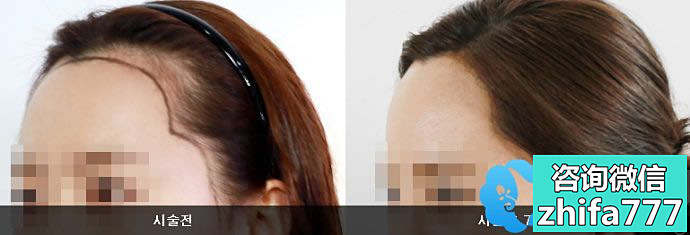 毛芽满植发案例 女性发际线调整手术
