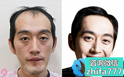 广州曙光医院植发案例 FUN纳米头发种植术后效果