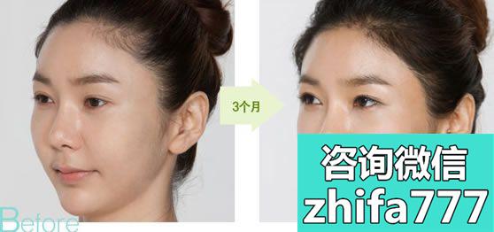 韩国高兰得植发案例 3D女性植发术治疗脱发