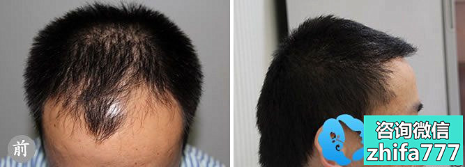 杭州格莱美植发案例 男性III级脱发患者成功手术