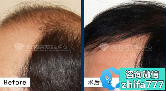 杭州格莱美植发案例 植发治疗前额头顶大面积脱发
