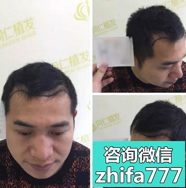 宁波同仁植发案例：M型发际线的刘老板种植头发后颜值暴涨