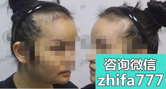 女性脂溢性脱发 广州新生种2800单位植发九个月后分享经历