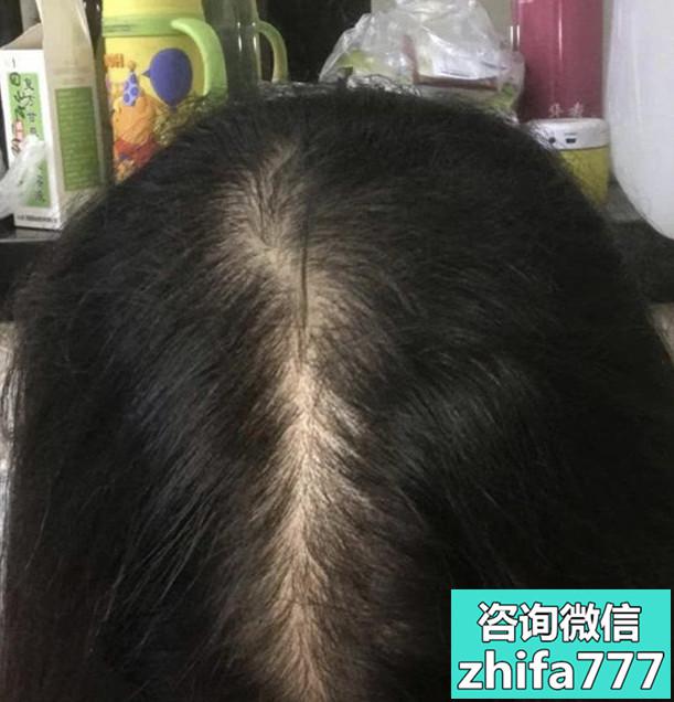 植发/头发种植/头顶加密种植 6个月后的效果
