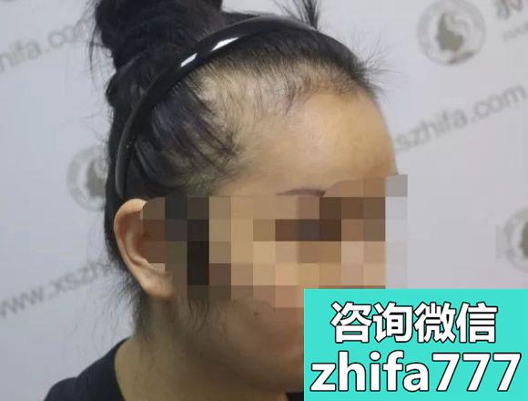 广州新生植发分享 女生种植头发真人案例（含效果图）