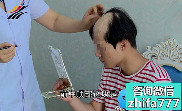 我找北京中德徐霞做疤痕植发修复 是因为她没有失败案例