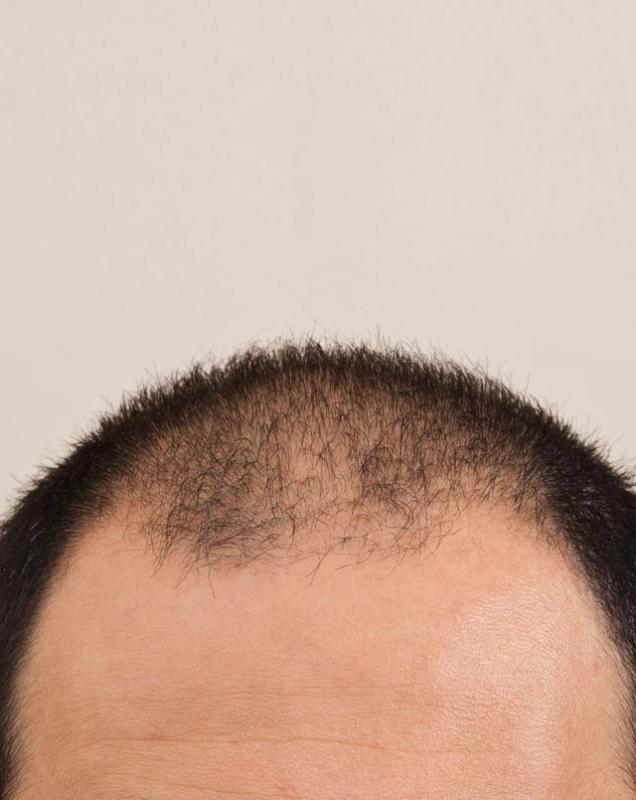 微创植发技术，呵护你的头皮健康，让秃顶不再遮遮掩掩