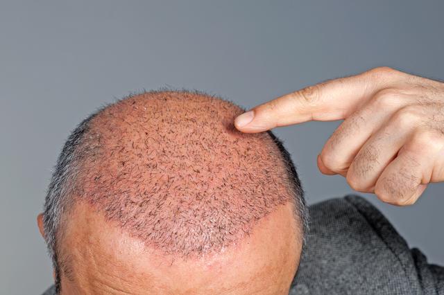植发技术简介：一篇介绍头发移植的科普文章