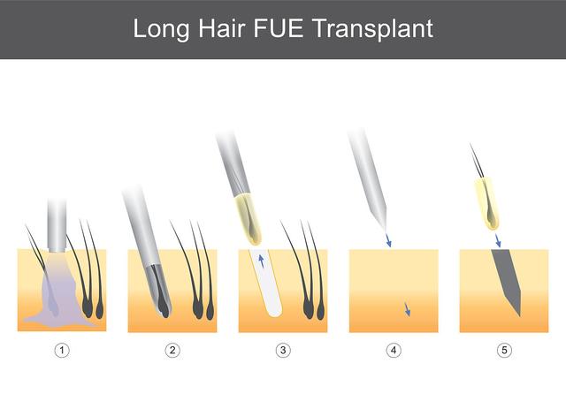 毛发移植术后哪些因素影响生长稳定健康？