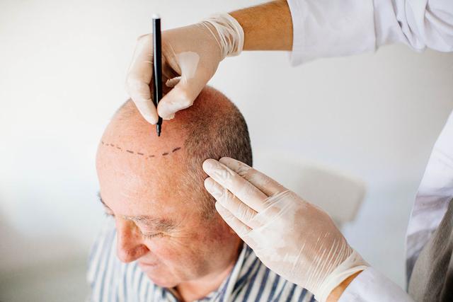 毛发移植术后哪些因素影响生长稳定健康？