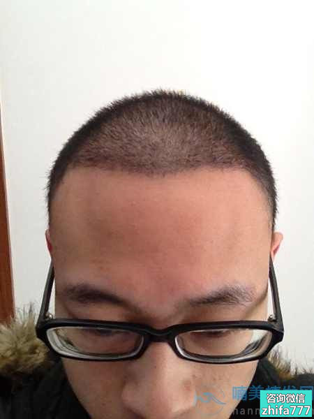 哈尔滨第二一植发际线，头发看起来很自然