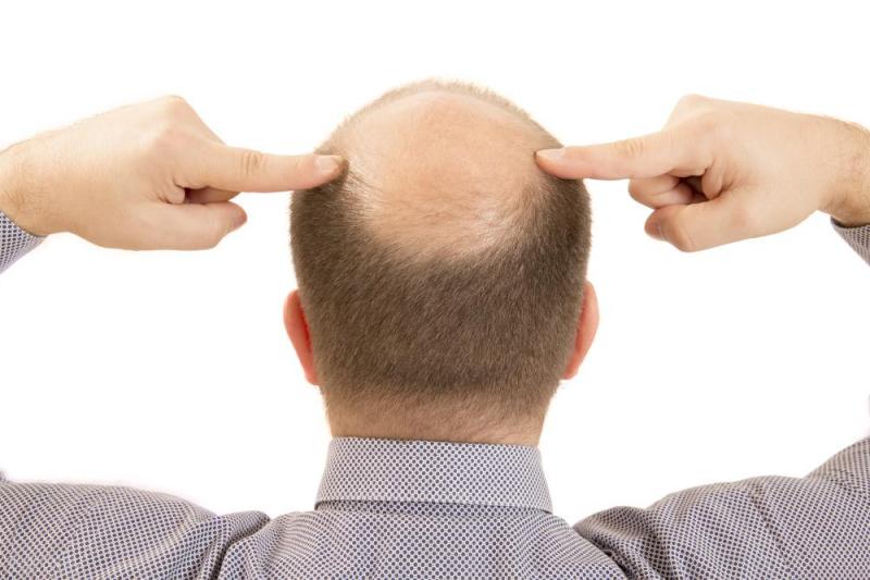 超2亿人受脱发困扰！脱发到底该怎么办？3个方法拯救你的发量
