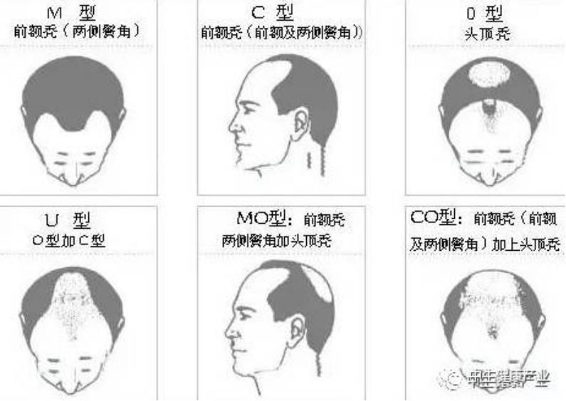 脱发科普：5种常见脱发类型及男女脱发区别，今天一次性讲清楚