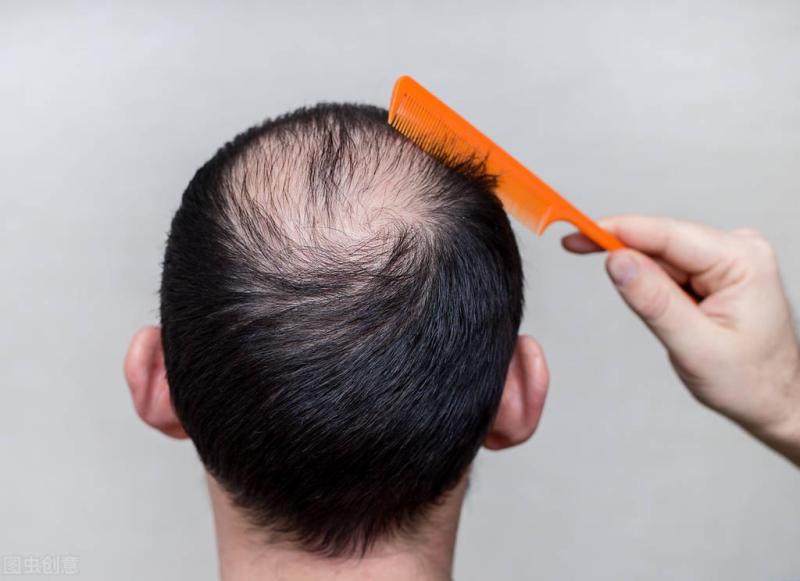脱发的人必看：老中医讲解脱发的分型和治疗方法，内附食疗方法