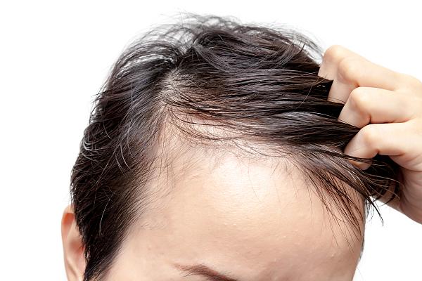“秃如起来”的植发经济成新风口 专家：植发不能阻止脱发