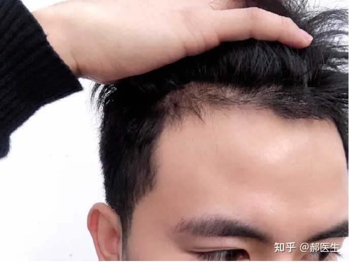 上海植发医院哪家好？或哪个植发医生靠谱？
