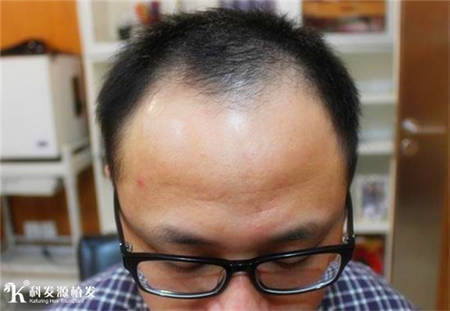 上海植发效果并不是种头发这么简单