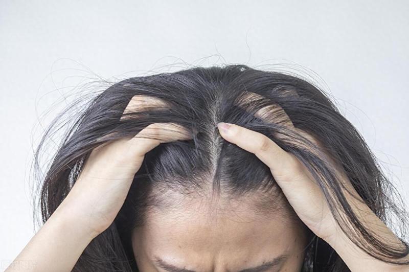 脱发不一定是肾虚引起的，4种更常见的脱发原因，学会就是你的