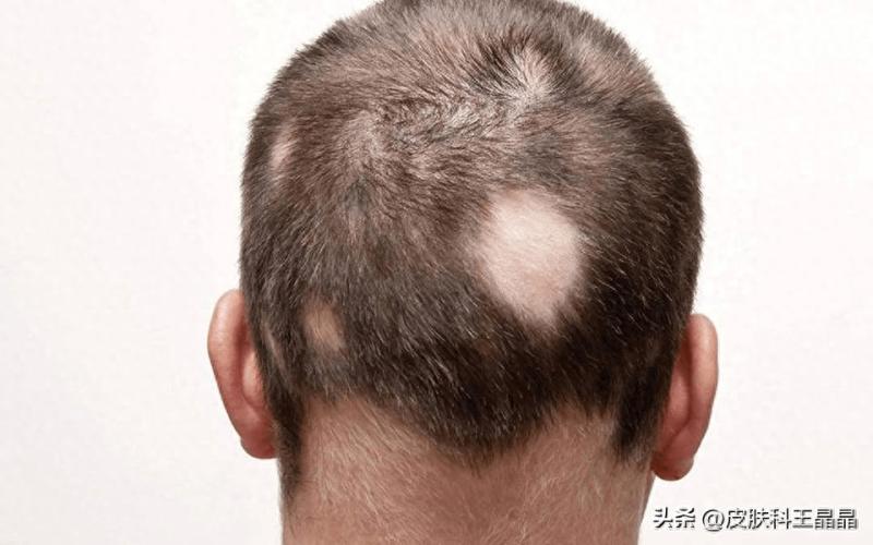 你秃头了吗？常见的脱发类型，你属于哪一种？