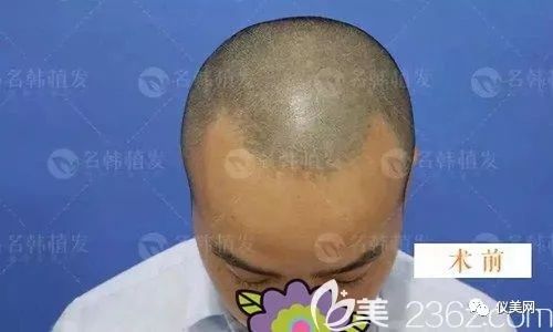 济南名韩植发做的前额发际线种植现在是术后4个月