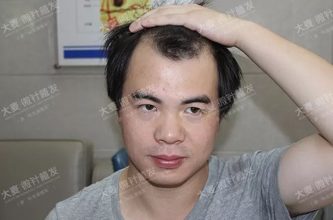 28岁大叔微针植发M型脱发如何解决挽救颜值？
