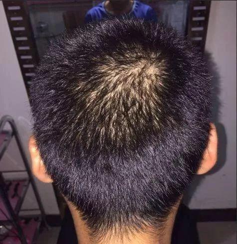 26岁男孩植发蜕变用6个月见证了从头发稀疏到浓密
