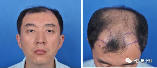 成都微针植发案例发际线植发头顶加密术后一年效果