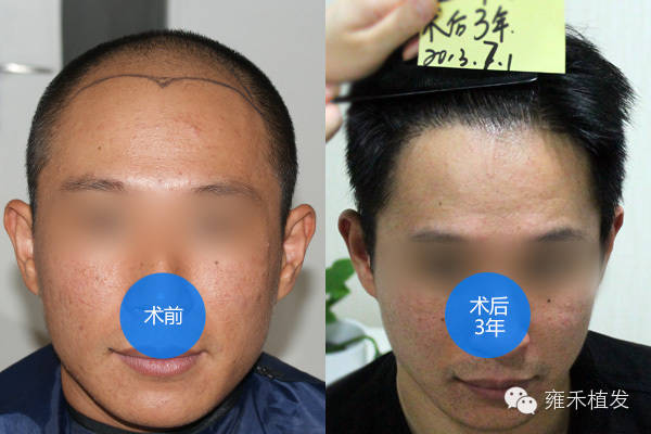 9年前的上海植发老案例你第一次见？植发2650单位