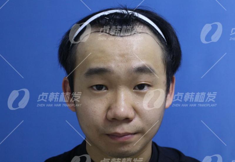 韩国教授说植发会更丑他不信邪偏要植发